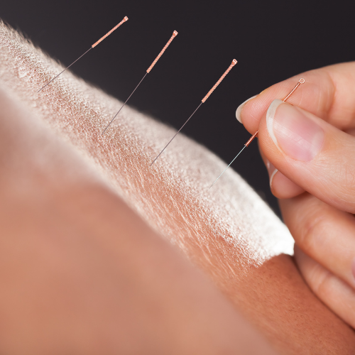 NDIS Acupuncture Australia